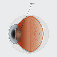 Cataract